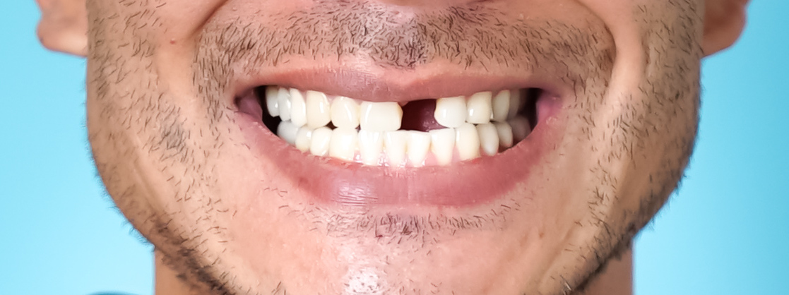 missing teeth